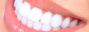 Dental Veneers