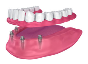 Implant Denture at Grand Parkway Smiles