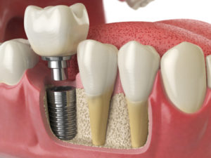 Dental Implant Katy Tx