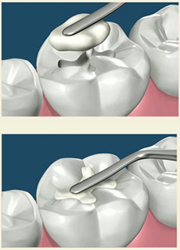 Tooth Colored Dental Fillings