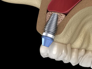 Vertical Sinus Lift Grand Parkway Smiles