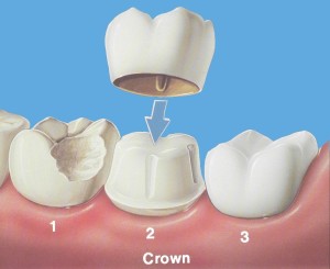Dental Crown Grand Parkway Smiles