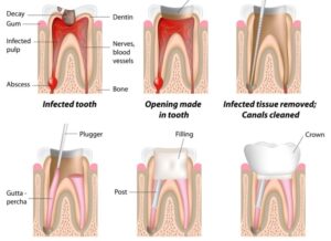 Root Canal