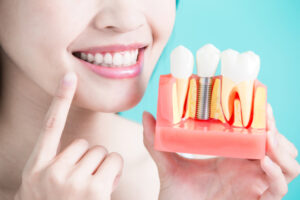 Dental implant patient in Katy, TX at Grand Parkway Smiles