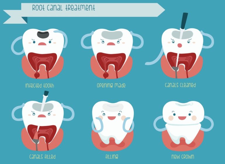 root canal treatment