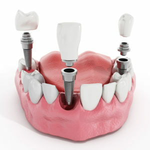 Dental Implants Grand Parkway Smiles
