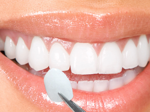 Dental Veneers Katy Tx