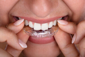 Invisalign Katy Tx