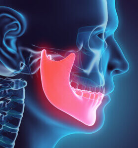 Osteonecrosis of the Jaw