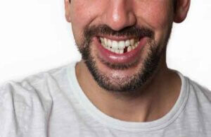 Dental Implants Katy