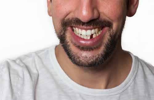 Dental Implants Katy