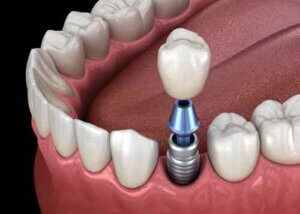 Houston Dental Impants