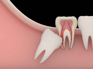 Wisdom Teeth Removal Houston