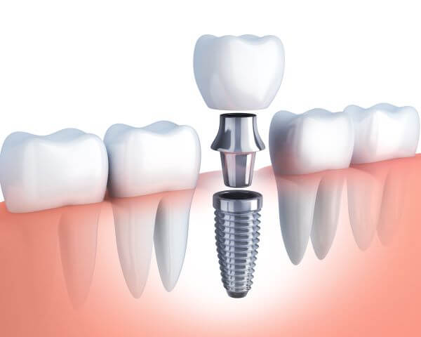 dental implants sugarland