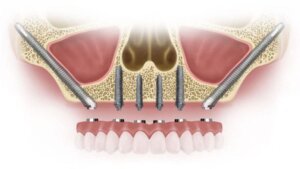 Zygomatic Implants