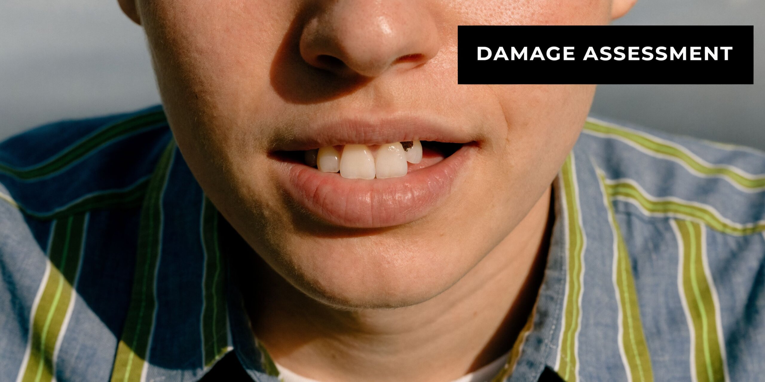 A close-up view of a person's mouth showing a small chip on their upper front tooth.