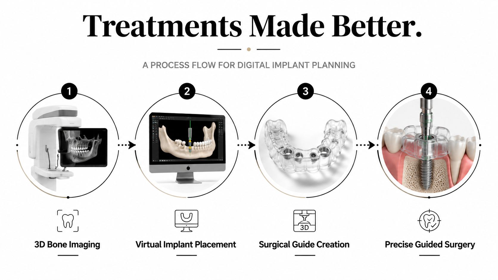 A four-step infographic illustrating the digital implant planning process from 3D imaging to guided dental surgery.