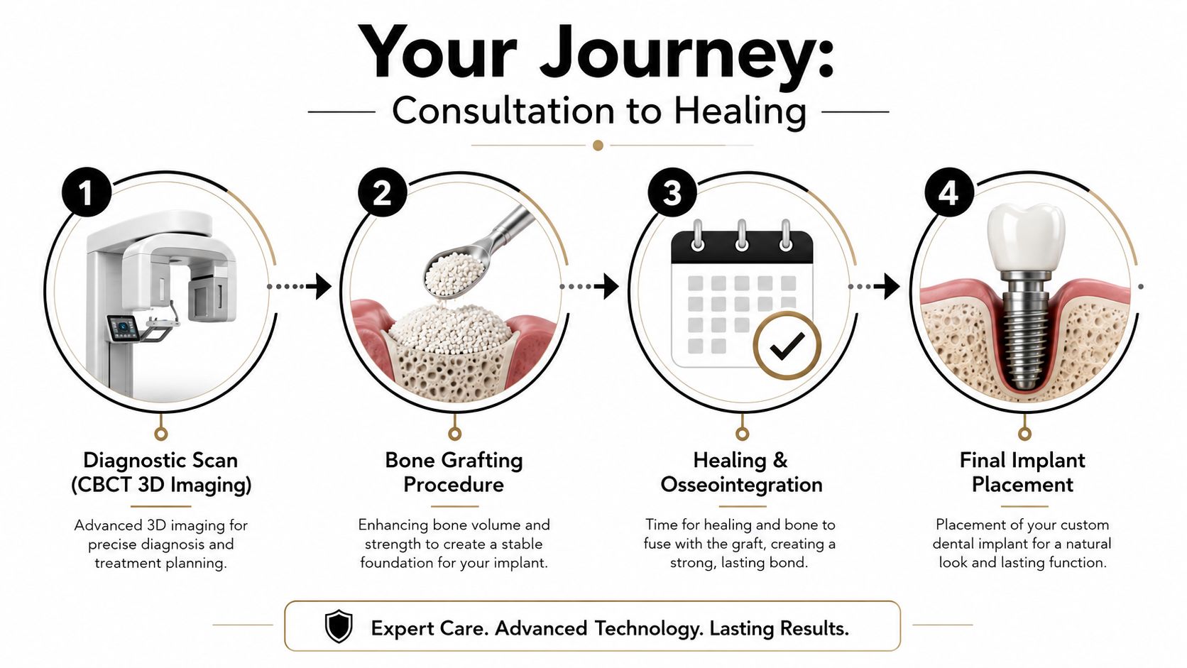 A four-step infographic showing the dental implant journey from diagnostic scan and bone grafting to final placement.